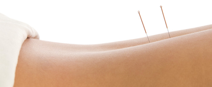 Medical Acupuncture